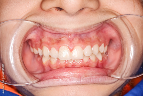 Frontal view of dental maxillary and mandibular arches in occlusion with biting teeth, cheeks and lips retracted with cheek retractor. Bad hygiene with gingival interdental papilla gum inflammation 