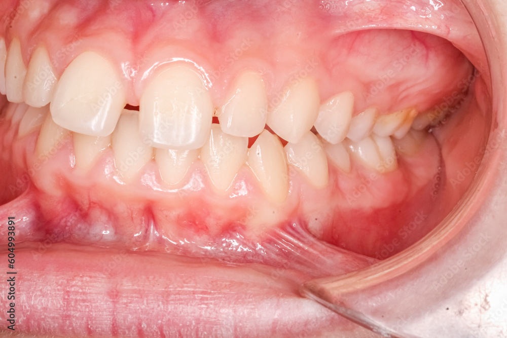 Foto de Lateral oblique view of dental maxillary and mandibular arches