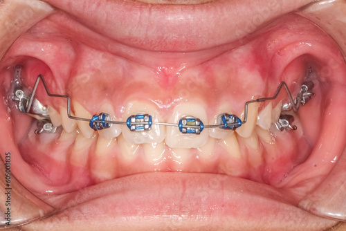 Frontal view of dental arches in biting teeth occlusion, orthodontic braces, blue colored elastic O-ring ligature and curved metallic arch wire. Cheeks and lips retracted with cheek retractor.