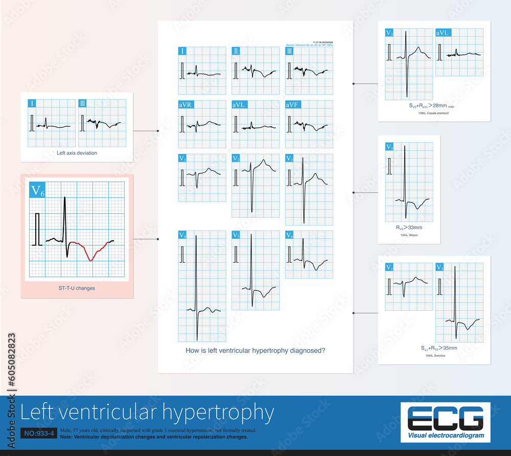 Common ECG changes in left ventricular hypertrophy include increased