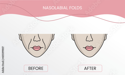 Nasolabial folds, laser cosmetology before procedure and after applying treatment in vector. Illustration of a woman with smooth clean skin and problematic skin.