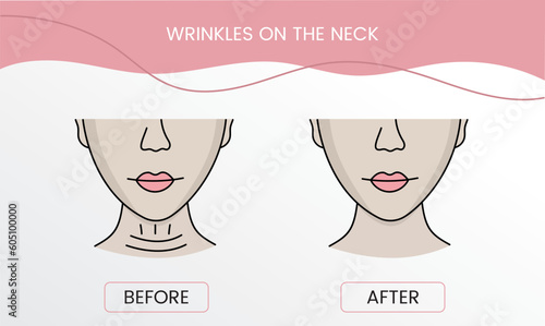 Wrinkles on the neck, laser cosmetology before procedure and after applying treatment in vector. Illustration of a woman with smooth clean skin and problematic skin.
