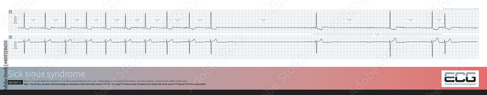An 81 year old elderly male was clinically diagnosed with coronary heart disease and cerebral vascular insufficiency. The dynamic electrocardiogram indicated sick sinus syndrome. An 81 year old elderly male was clinically diagnosed with coronary heart disease and cerebral vascular insufficiency. The dynamic electrocardiogram indicated sick sinus syndrome.