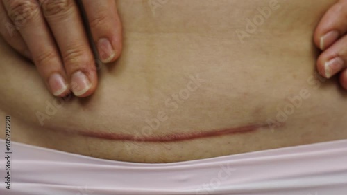 close up belly of woman with a c-section scar of caesarean

 photo