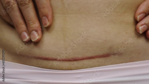 close up belly of woman with a c-section scar of caesarean

