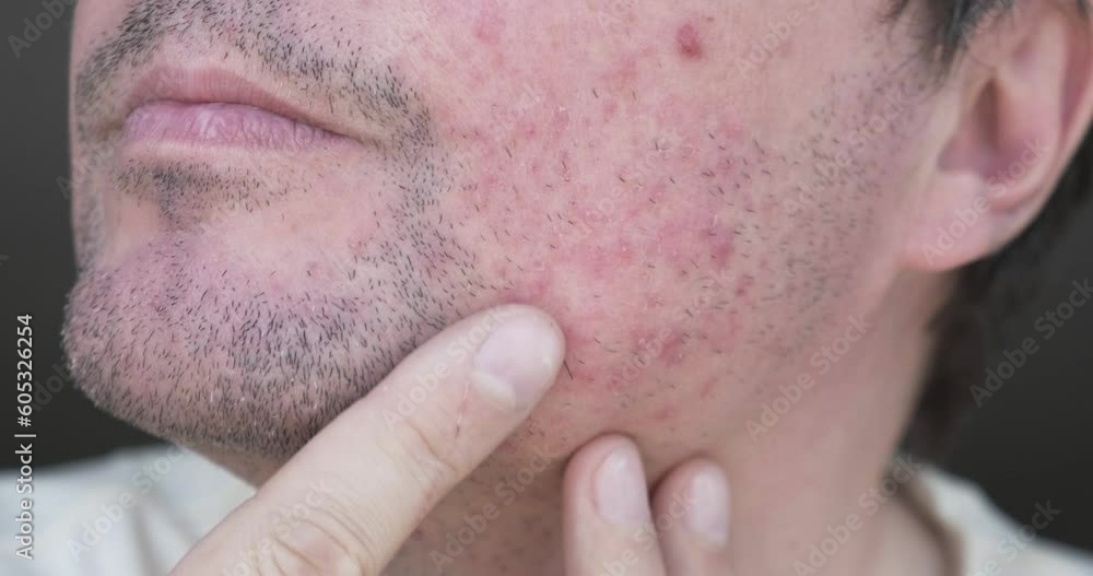 Man checks dermatitis on face. Eczema close up. Man checks dermatitis on face. Eczema close up.