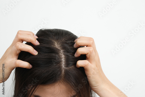 Slika na platnu A woman has problems with hair and scalp,she has dandruff from allergic reactions to shampoos