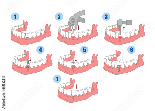Dental implant installation process stages educational scheme isometric vector illustration