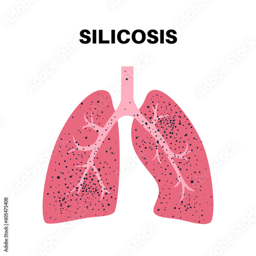 Silicosis dust in lung