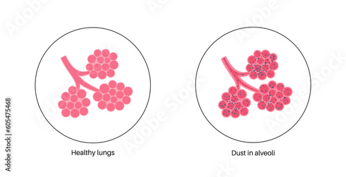 Pneumoconiosis lung disease