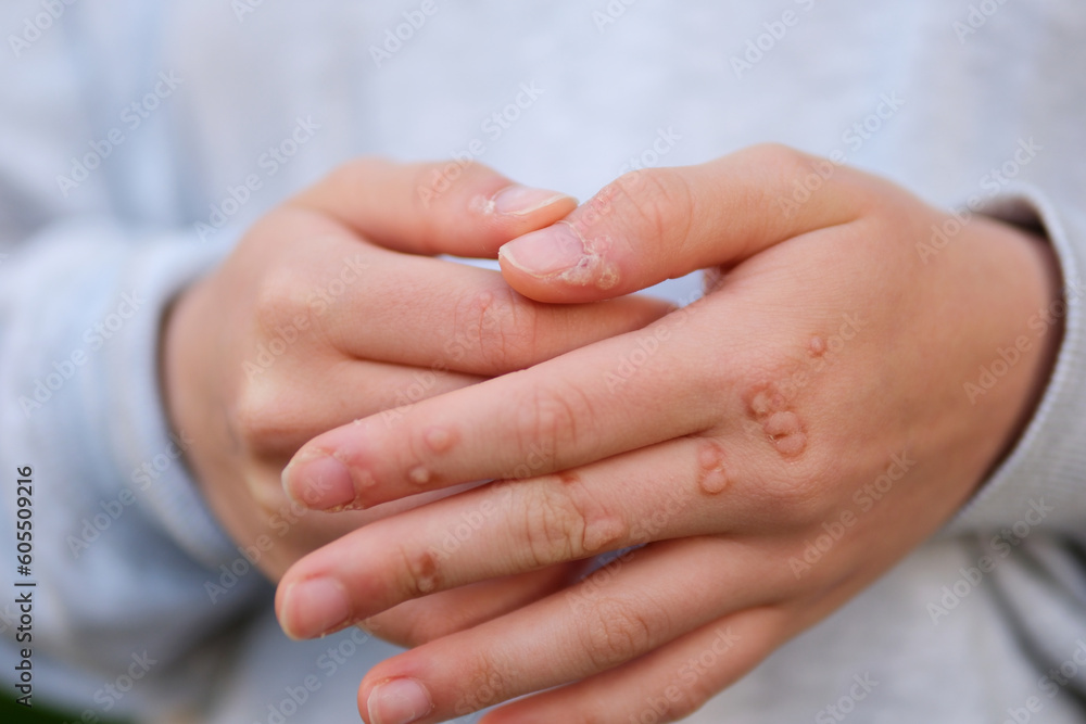 Hand with wart man skin closeup hands of young teenage girl are strewn with warts a lot of papillomas viral infection on hands touch scratching consider near nail viral infection growths on fingers - obrazy, fototapety, plakaty 