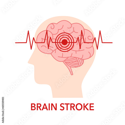 Human brain stroke problem in flat design. Brain disease.