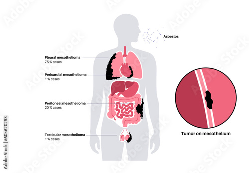 Mesothelioma tumor types