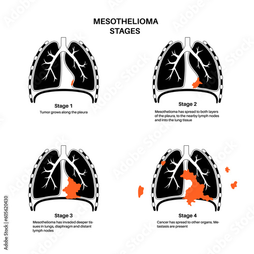 Mesothelioma cancer stages