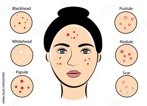 Face of a girl with pimples on a white background. Acne stages. Vector illustration in doodle style