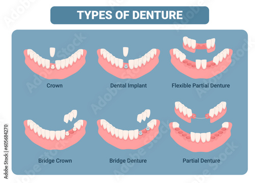 Dental prosthesis types educational medical scheme with names isometric vector illustration