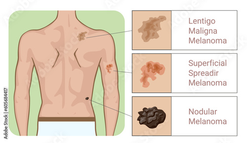 Melanoma types dermatology disease on human back example medical education scheme vector flat