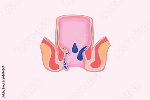 Cross section of the rectum and anal canal. hemorrhoids illustration. eps 10
