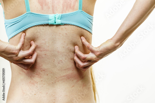 Woman scratching her itchy back with allergy rash