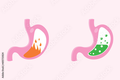 illustration of pyrosis stomach and nausea stomach. Pyrosis fire disorder, gastric acid reflux. Stomach medical illustration set. eps 10