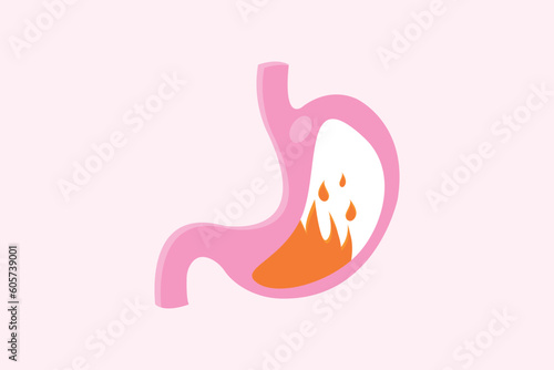 medical illustration of pyrosis stomach isolated. Fire disorder inside stomach.