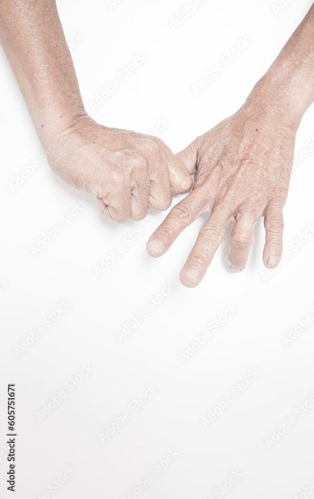 Fototapeta premium Trigger Finger a defect in a tendon causing a finger to jerk or snap straight when the hand is extended.