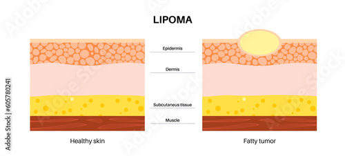 Lipoma medical poster