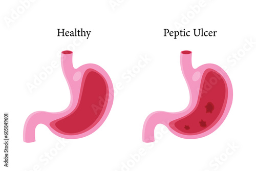 Stomach icon set, cartoon vector illustration. cross section of  normal and abnormal stomach