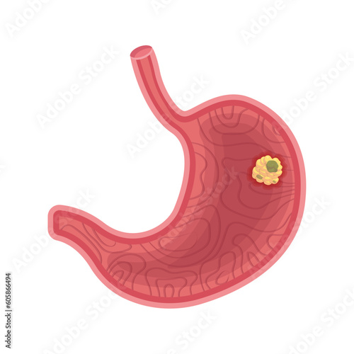 Stomach cancer vector illustration isolated on white background