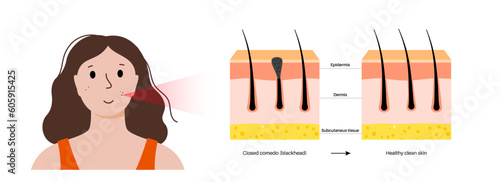 Acne treatment poster