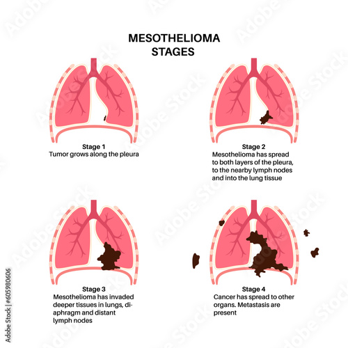 Mesothelioma cancer stages