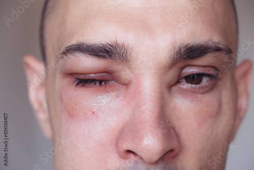 Valokuva Caucasian man has angioedema around the eyes caused by allergic reaction to agents such as insect bites, foods, or medications
