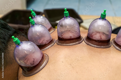 Traditional blood cupping therapy being performed on a patient's back
