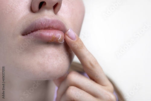 cold sores hpv virus herpes on girl female big beautiful lips.woman applying cream for treatment or healing patch.girl putting finger feeling pain, ouch gesture. photo