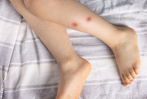 Slika na platnu kid child boy legs with mosquito bite big red spots