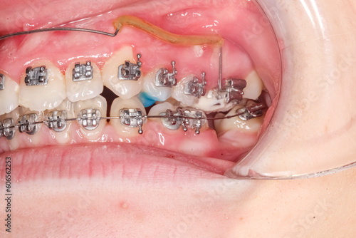 Lateral oblique view of dental arches in biting teeth occlusion with molar bite-raising blue resin material, orthodontic braces, arch wire, healthy gingival gum, lips retracted with cheek retractor. photo