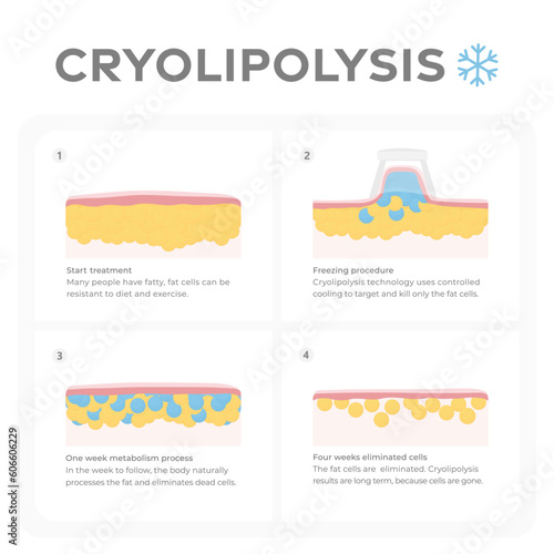 Vector infographic of the cryolipolysis process.
Layers of skin and tissues, before and after fat freezing treatment.
Graphic design illustration of fat freezing and reduction of fat cells
 photo