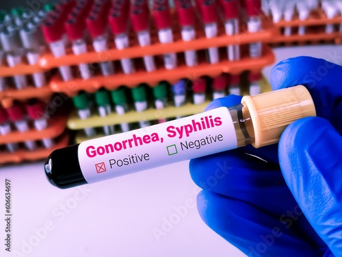 Doctor holding a blood sample for Syphilis and Gonorrhea test. VDRL, TPHA. photo