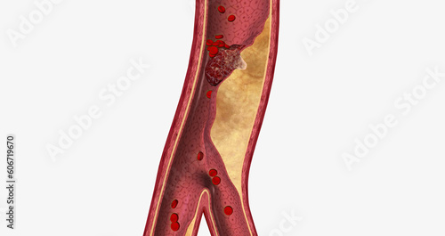 Atherosclerosis is a cardiovascular disease characterized by the gradual buildup of plaque in artery walls.