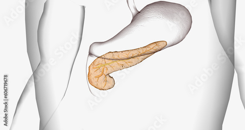 Cystic fibrosis (CF) is a genetic disorder characterized by thick mucus production. photo