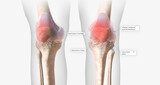 Rheumatoid arthritis (RA) is a chronic, autoimmune, inflammatory condition.