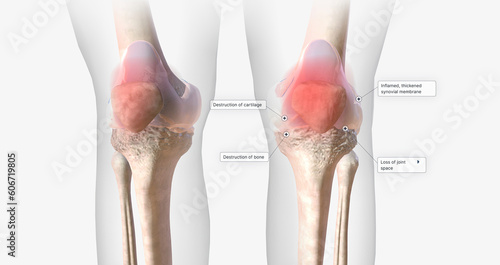 Rheumatoid arthritis (RA) is a chronic, autoimmune, inflammatory condition.