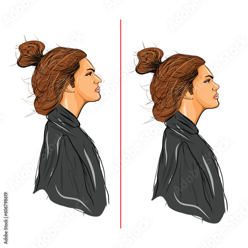 vectorial nose surgery, before and after