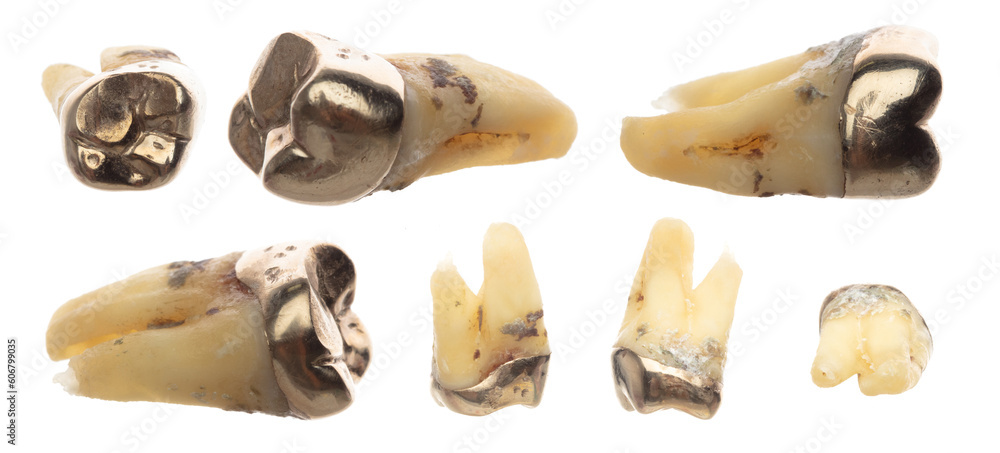 pulled-molar-tooth-with-gold-crown-to-show-many-angle-advanced-caries