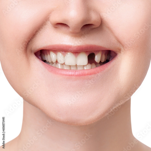 Woman teeth with hole. Dental implant concept.