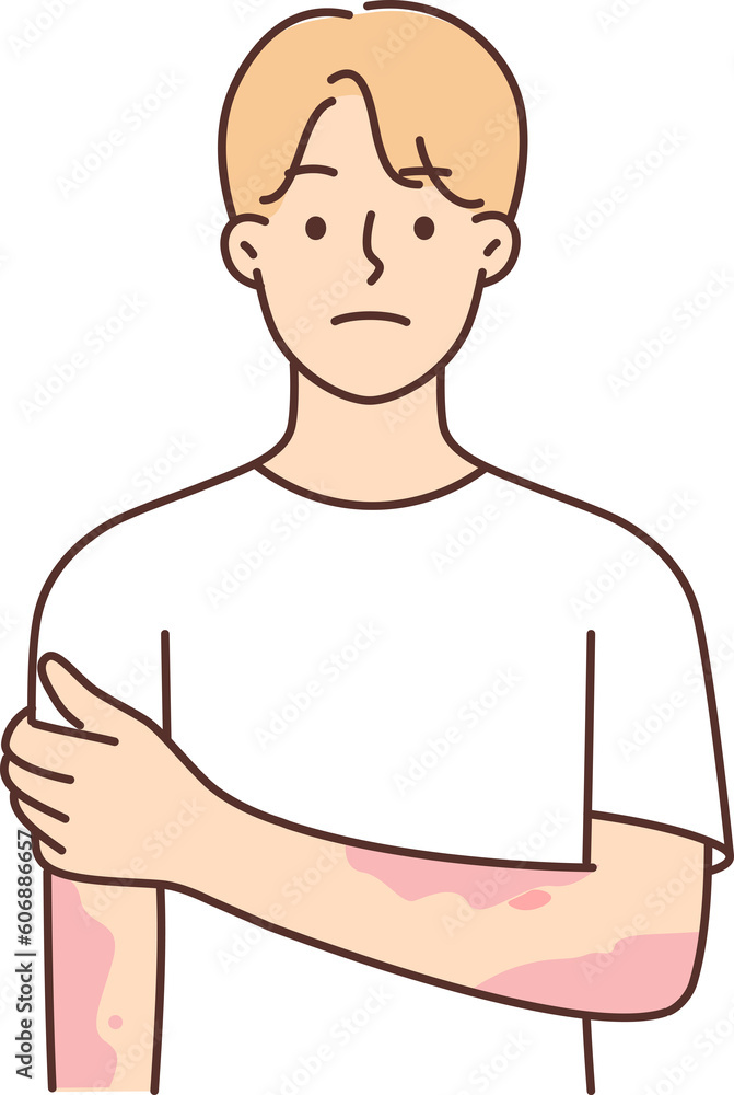 Man suffering from dermatitis and skin diseases with spots on hands needs help of dermatologist Man suffering from dermatitis and skin diseases with spots on hands needs help of dermatologist