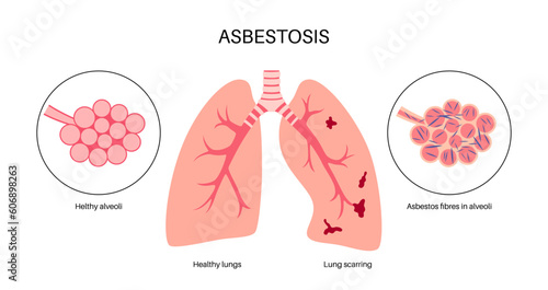 Asbestosis lung disease