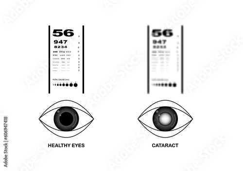 Comparison of healthy eyes and cataract eyes vision on eye examination chart.