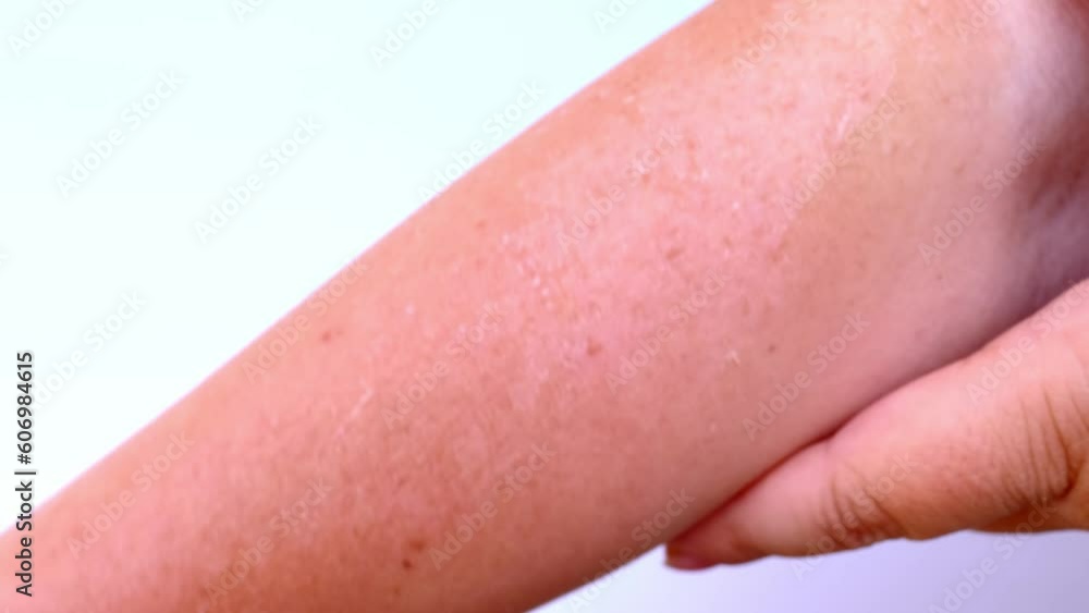 sunburn on skin, exfoliation of epithelium, severe peeling of the skin after sunburn, hands of an elderly woman in wrinkles close-up, harmful effects of sun, concept of beauty and spa procedures sunburn on skin, exfoliation of epithelium, severe peeling of the skin after sunburn, hands of an elderly woman in wrinkles close-up, harmful effects of sun, concept of beauty and spa procedures