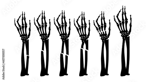 human hand fractures
